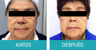 Antes y Despues Dermapen
