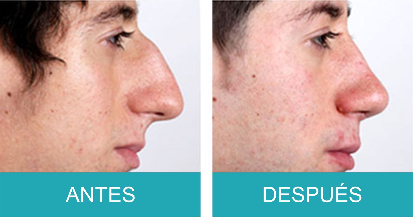 Antes y Despues Rinoplastia
