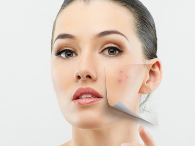 Tratamiento de Acne
