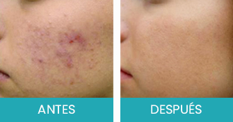 Antes y Despues Tratamiento de Acne