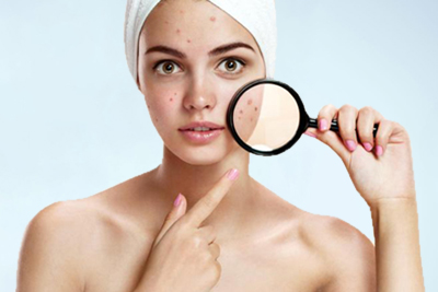 Tratamiento de Acne