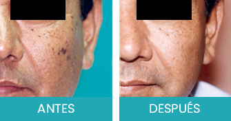 Antes y Despues Tratamiento de Manchas