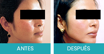 Antes y Despues Tratamiento de Manchas
